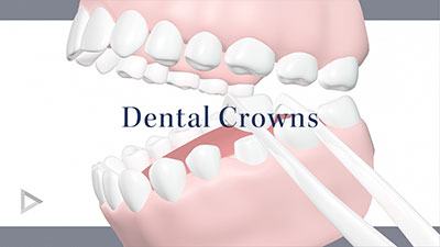 crowns