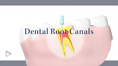 root canals